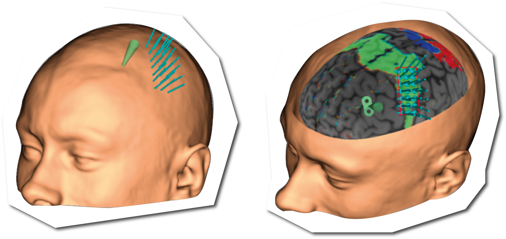 Brainsight Neuronavigation System | Brainbox